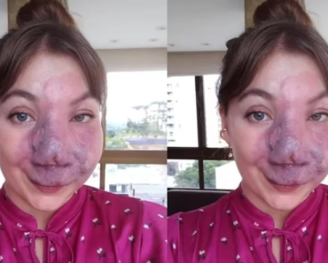 Une femme atteinte d’un hémangiome au visage est critiquée depuis qu’elle est enfant : « ils me regardent avec peur et pitié, mais j’aime mon visage »