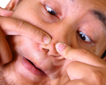 ST10. Pourquoi avez-vous des boutons dans le nez et comment y remédier ?