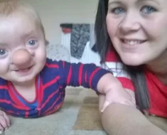 Remarkable Transformation: Baby Nicknamed Pinocchio Shows Incredible Evolution Over Time