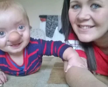 Remarkable Transformation: Baby Nicknamed Pinocchio Shows Incredible Evolution Over Time