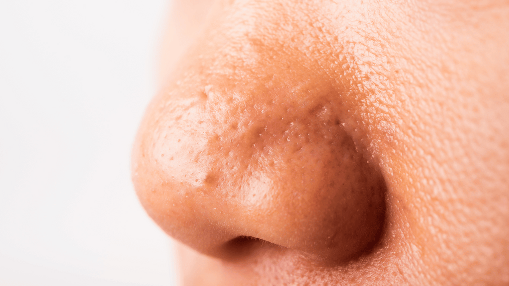 Nasal Pimples: How to Get Rid of Pimples on Nose | Clinikally