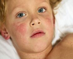 Mon enfant a de l’urticaire. L’urticaire est-elle la même chose que les allergies ?