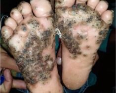 Girl catches jigger, the worst happens and the case shocks the doctors who treated her
