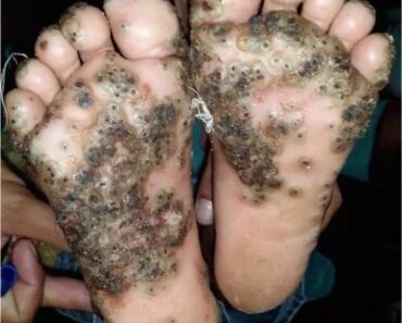 Girl catches jigger, the worst happens and the case shocks the doctors who treated her