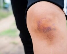 HT4. BE CAREFUL, if you get these bruises on your body, here’s what…