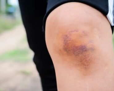 HT4. BE CAREFUL, if you get these bruises on your body, here’s what…