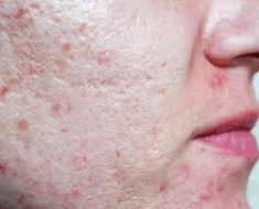 SEVEN THINGS THAT CLOG YOUR PORES AND CAUSE ACNE