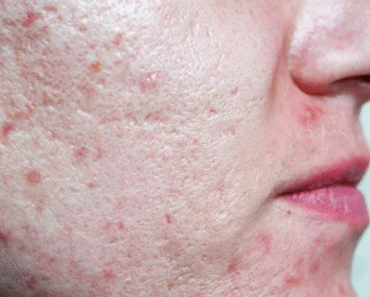 SEVEN THINGS THAT CLOG YOUR PORES AND CAUSE ACNE