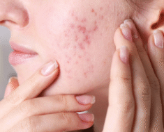 7 choses qui obstruent vos pores et provoquent de l’acné