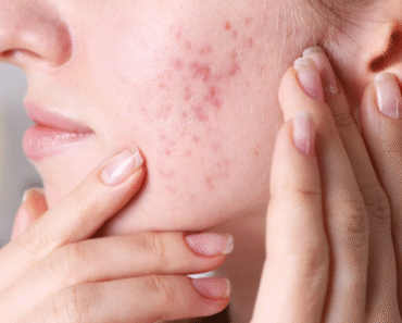 7 choses qui obstruent vos pores et provoquent de l’acné