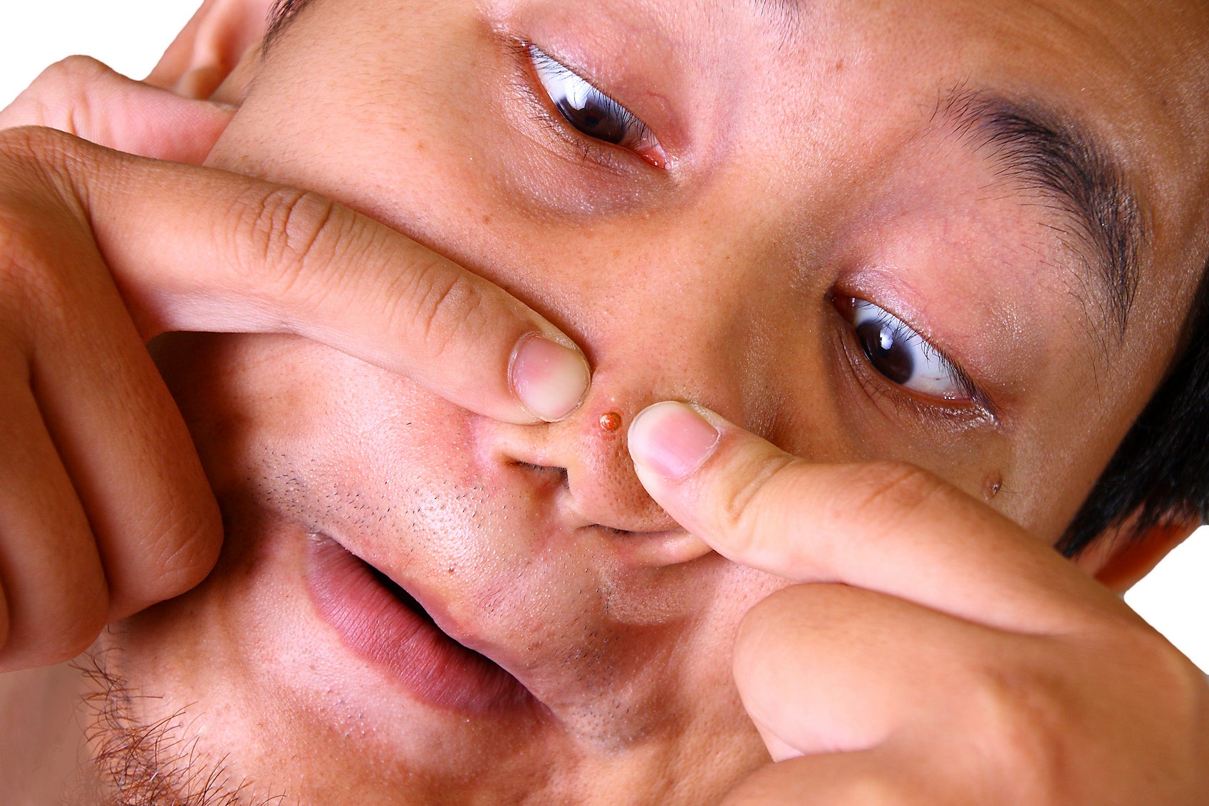 The danger triangle: How squeezing spots can kill you (if you're very unlucky) | The Independent | The Independent