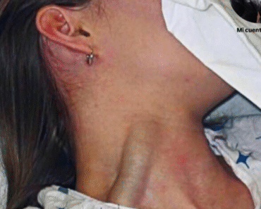 Massive jugular vein distension: a sign not to be ignored