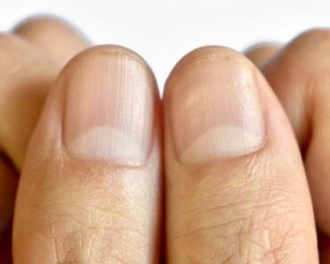 Having Striped Nails Could Mean That Your Body is…