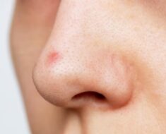 ST10. Why You Keep Getting Pimples Inside Your Nose, and What to Do About It