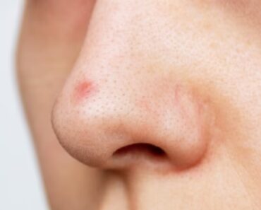 ST10. Why You Keep Getting Pimples Inside Your Nose, and What to Do About It