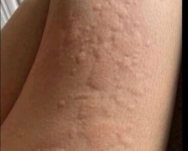 His whole body was itchy, he thought it was an allergy and was diagnosed w…See more