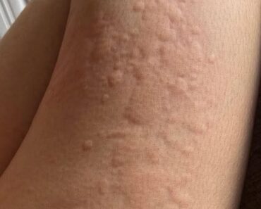 Her Whole Body Was Itchy: What She Thought Was a Common Allergy Was Hiding Something More Serious