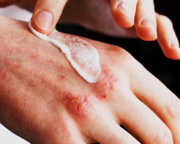 Warning signs you should never ignore on your skin