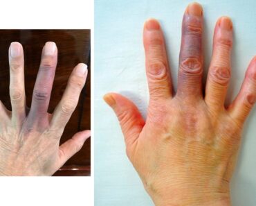 HT13. 3 Signs on Your Hands That Could Indicate Heart Disease or Cancer