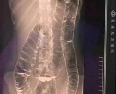 Severe Constipation and Toxic Megacolon: Causes and Solutions