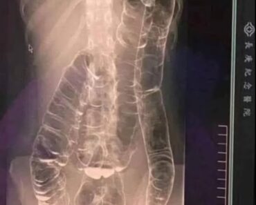 Severe Constipation and Toxic Megacolon: Causes and Solutions