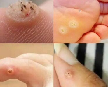Be Very Careful: If You Notice This Skin Growth, It Could Be Serious