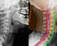 A Life-Altering Incident: Heavy Object Falling on Head Caused Fatal Cervical Spine Fracture in 18-Year-Old Worker