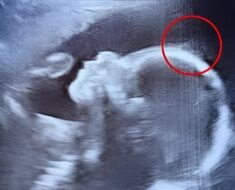 Doctors couldn’t believe what they saw during the ultrasound. But when the baby girl was born, her charm, strength, and story touched hearts around the world in the most unexpected way.