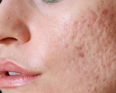 How to Get Rid of Acne: Causes, Treatments, and Prevention Tips