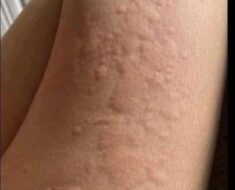 When an Itch Isn’t Just an Itch: James’s Story and the Silent Warning Signs of Skin Conditions