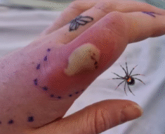 What to do if you get bit.ten by a black widow spider: A complete guide