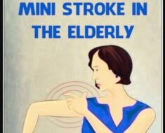 Understanding Mini Strokes in the Elderly
