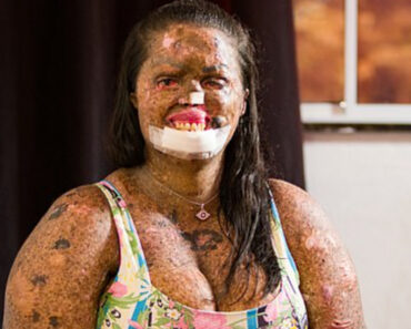 Woman with rare skin condition overcomes negativity and finds true love