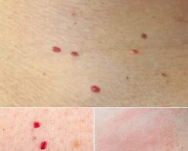 If you spot these red dots on your skin, here Is what they mean!!