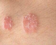 HT9. Warning signs you should never ignore on your skin