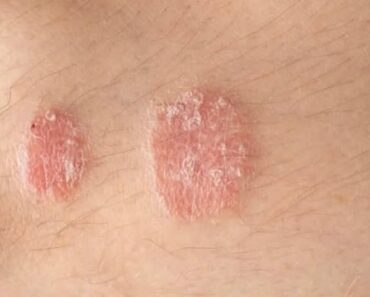 HT9. Warning signs you should never ignore on your skin
