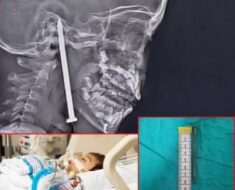 Year-Old Boy Survives After 3-Inch Nail Pierces His Brain In Shocking Playground Accident!!!