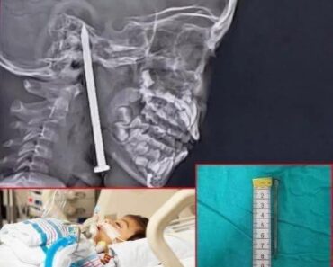 Year-Old Boy Survives After 3-Inch Nail Pierces His Brain In Shocking Playground Accident!!!