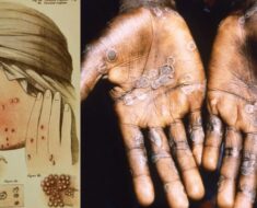 ST13. The Scariest Diseases in Human History: When Illness Reshaped Civilization