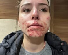 The Hidden Reasons You Keep Getting Pimples on Your Chin