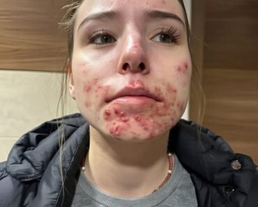 The Hidden Reasons You Keep Getting Pimples on Your Chin