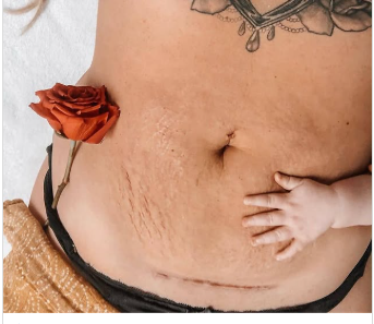 Healthy Moms Get Honest About Post-Baby Bodies — And Fans Are Cheering