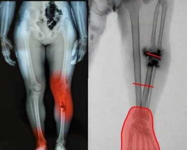 Viral Post Claims COVID-19 Vaccines Cause Severe Limb Damage, Experts Urge Caution Against Misinformation!