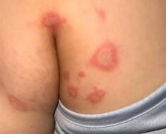 HT9. Why Bumps Appear in These Places