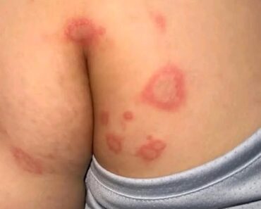 HT9. Why Bumps Appear in These Places
