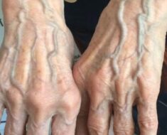 When to Worry About Veins That Appear Out of Nowhere!?