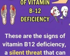 Common Signs and Symptoms of Vitamin B12 Deficiency!